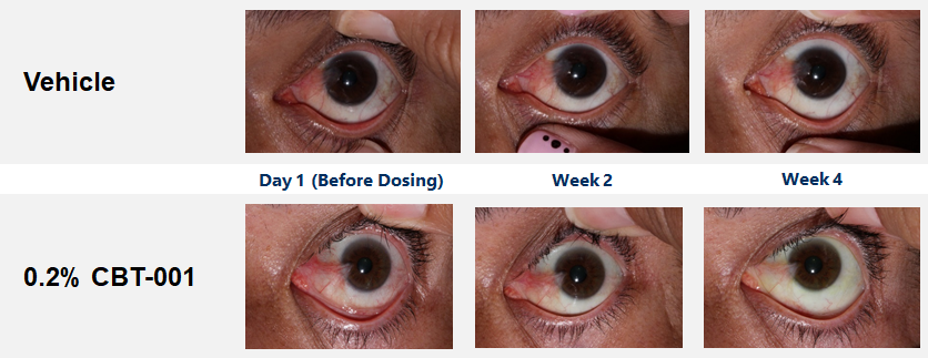 change in eye health of patient with pterygium due to CBT-001 treatment